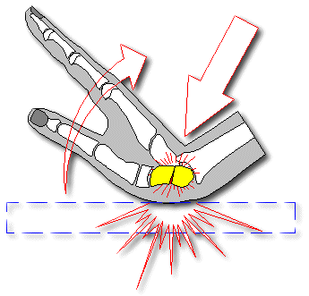 scaphoid fracture